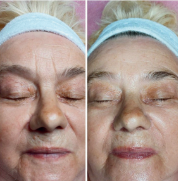 BioRenew Larens Pro Lift